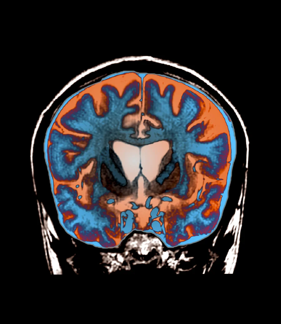 MRI image of a patient with Huntington's Disease.